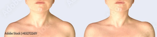Obraz front of neck and shouledrs before and after botulinum toxin.