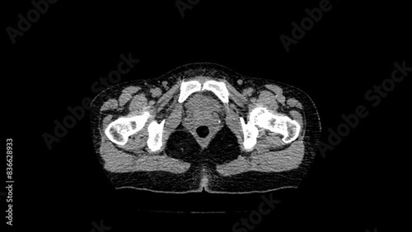 Fototapeta normal abdomen CT  scan 