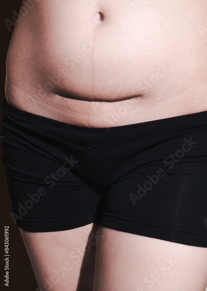 Obraz scar of cesarean section in the belly area