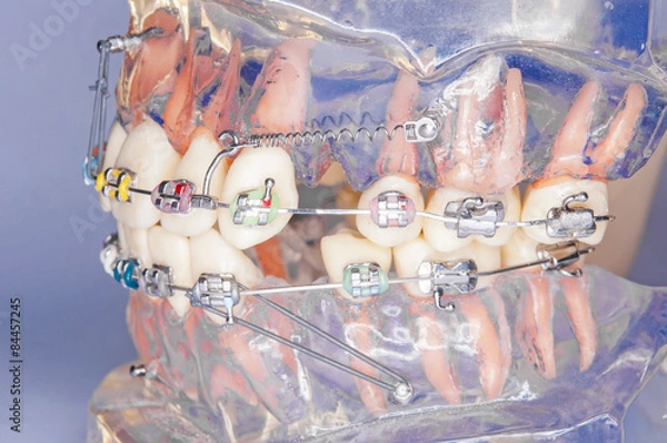 Obraz Braces model with miniscrew