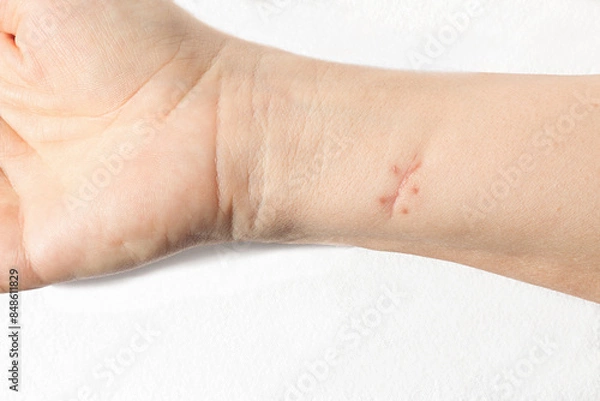 Fototapeta Scar from a sutured wound on white skin forearm. Isolated