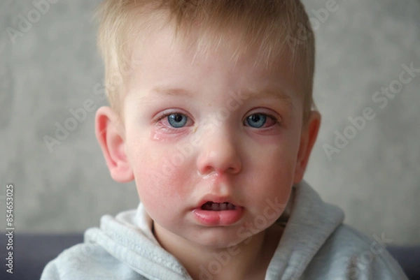 Obraz Red swollen eyes from conjunctivitis child, ill allergic eyes in babies. Close-up of a baby with conjunctivitis