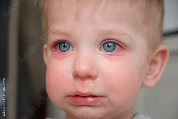 Obraz Red swollen eyes from conjunctivitis child, ill allergic eyes in babies. Close-up of a baby with conjunctivitis