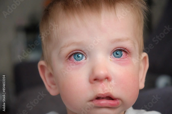 Obraz Red swollen eyes from conjunctivitis child, ill allergic eyes in babies. Close-up of a baby with conjunctivitis