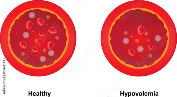 Fototapeta Hypovolemia