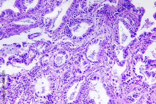 Fototapeta Well differentiated adenocarcinoma of a human