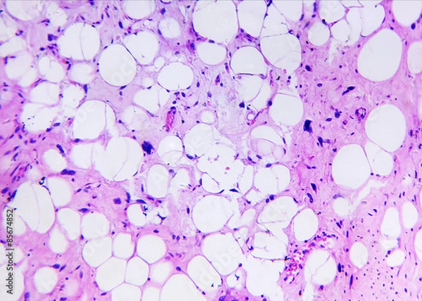 Fototapeta Liposarcoma of a human