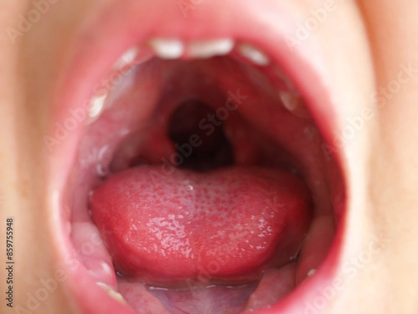 Obraz Child girl showing an uvula in a cleft palate. Closeup photo, blurred.