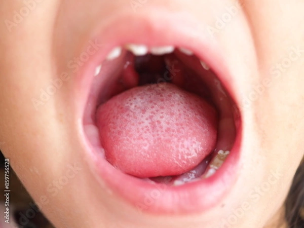 Obraz Child girl showing an uvula in a cleft palate. Closeup photo, blurred.