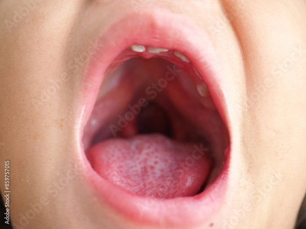 Obraz Child girl showing an uvula in a cleft palate. Closeup photo, blurred.