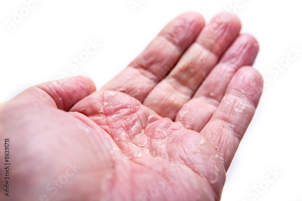 Fototapeta The problem with many people - eczema on hand. Isolated