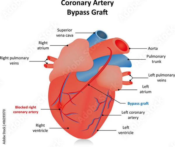 Fototapeta Coronary Artery Bypass Graft 