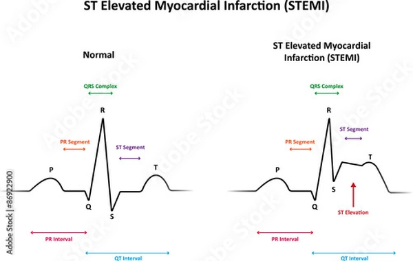 Fototapeta ST Elevated Myocardial Infarction