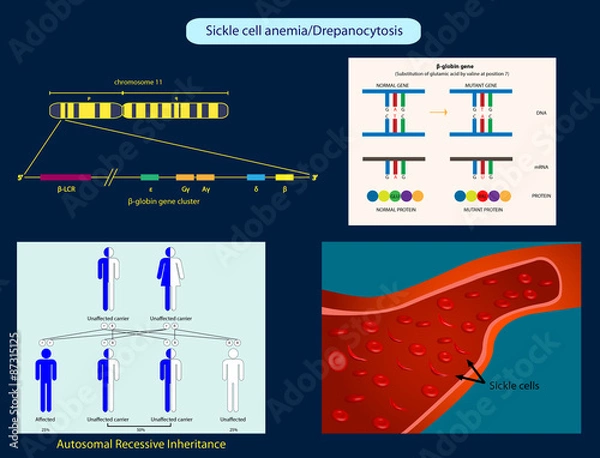 Obraz Sickle-cell anemia
