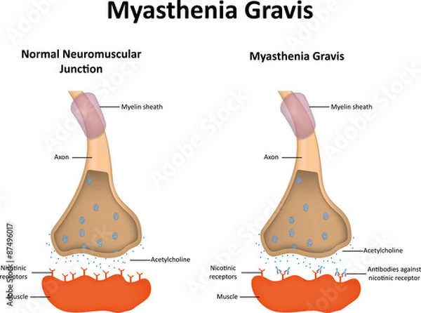 Fototapeta Myasthenia Gravis
