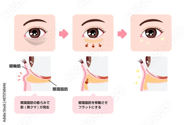 Fototapeta 目のくま（黒クマ) の除去手術 図解イラスト (ハムラ法・裏ハムラ法)
