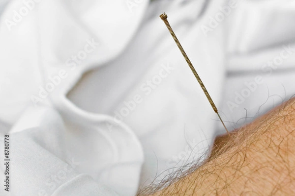 Obraz Acupuncture needle in arm (2)