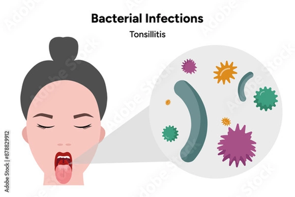 Obraz Bacterial infection tonsillitis 