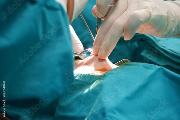 Obraz Surgeon performs open nose surgery to pull out the silicone