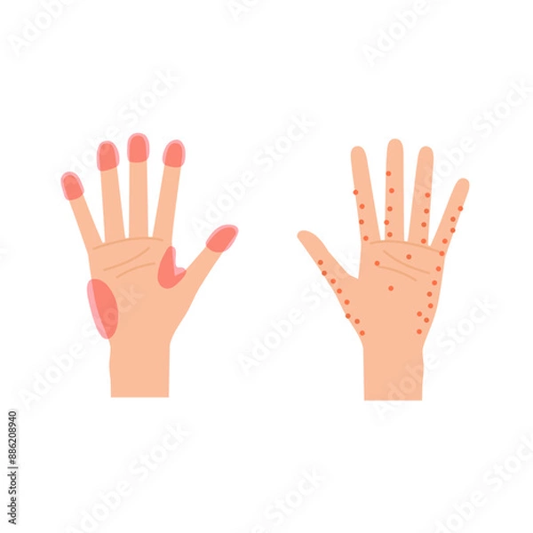 Fototapeta 手湿疹と汗疱のよく発症する部位のイメージイラスト（女性の手）