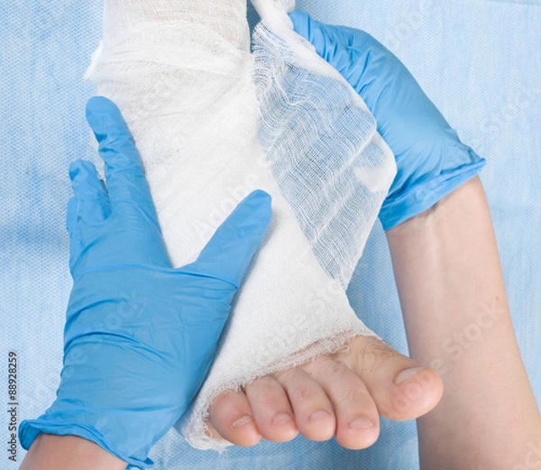 Obraz bandaged leg plaster in hospital