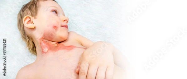 Obraz medical procedure dressing a boy with a first-degree burn from boiling water on his face, neck and chest