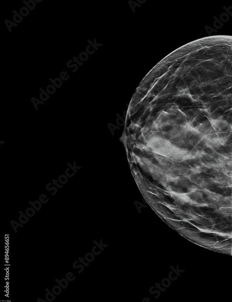 Obraz Mammogram. Left bilateral craniocaudal (CC) view (with tomosynthesis and C-view reconstruction), fibroglandular and lipomatous structure (ACR C), benign bilateral calcifications, breast cysts present