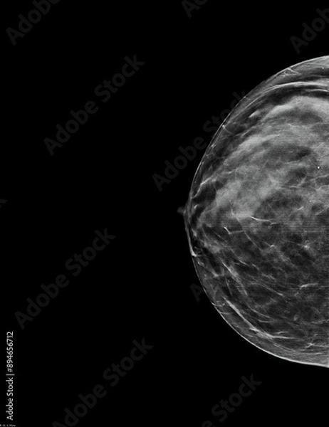 Obraz Mammogram. Right bilateral craniocaudal (CC) view (with tomosynthesis and C-view reconstruction), fibroglandular and lipomatous structure (ACR C), benign bilateral calcifications, breast cysts present