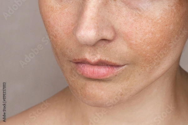 Fototapeta Close up caucasian woman's face with freckles or age spots. Age spots on the face melasma