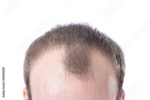 Obraz Man's Receding Hairline