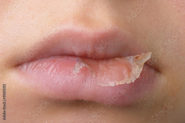 Obraz Hautablösung an Lippe durch Xerotisches Ekzem frontal