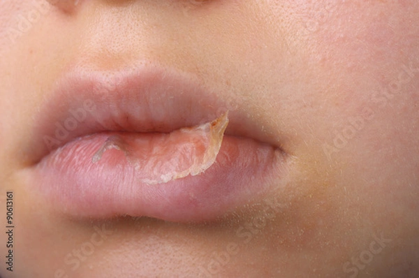 Obraz Hautablösung an Lippe durch Xerotisches Ekzem seiliche Ansicht