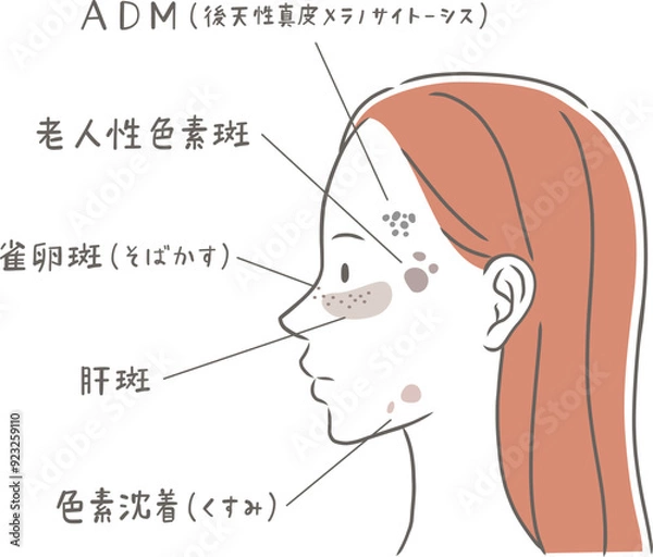 Fototapeta シミの種類と横顔の女性のイラスト素材