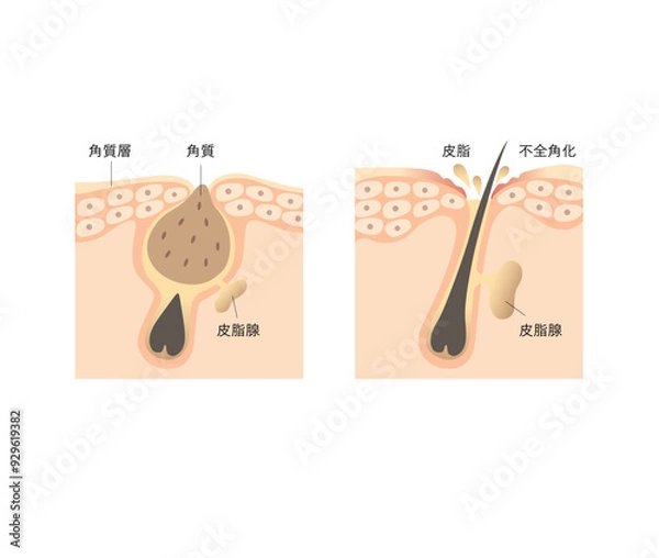 Obraz 図版_肌図版_007_毛穴詰まりと皮脂
