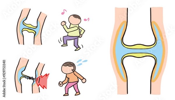 Fototapeta 膝の痛みのベクターイラスト