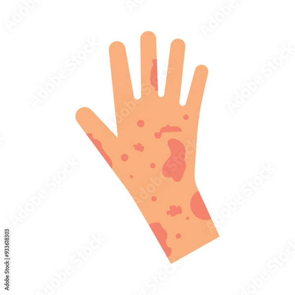 Obraz Skin rash, insect bites allergy reaction. irritation on hand logo vector illustration