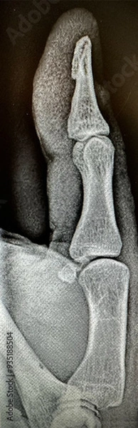 Obraz Thumb X-ray