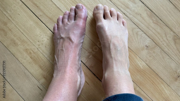 Obraz Foot Infection