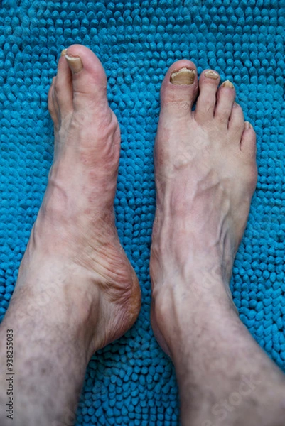 Fototapeta detalhe de pés com micose nas unhas e pele com irritação, fungos.,