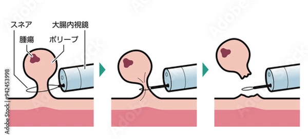 Fototapeta 内視鏡的ポリープ切除術　図解