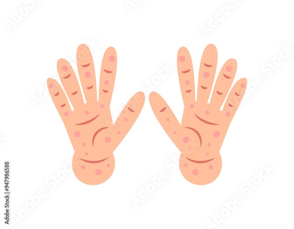 Fototapeta illustration of two palms covered with rashes and wounds. red spots on hands. symptoms of Singapore flu or chicken pox. hand and skin diseases. health problems. flat style design. graphic elements