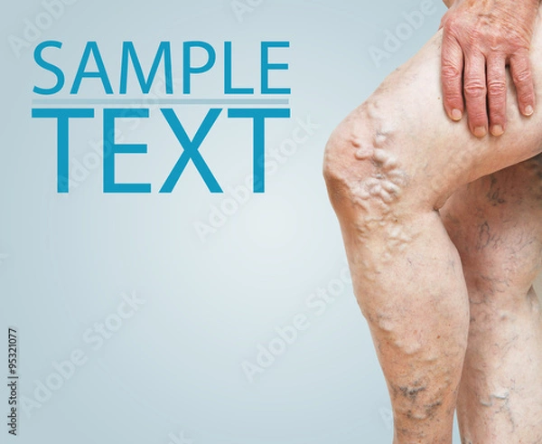 Obraz Nogi z żylakami