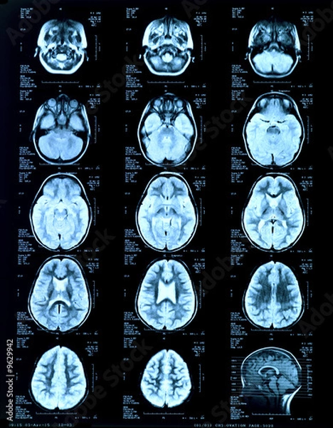 Obraz children's head Magnetic risonance image MRI