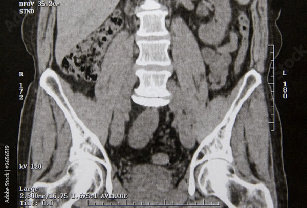 Obraz Abdominal CT scan