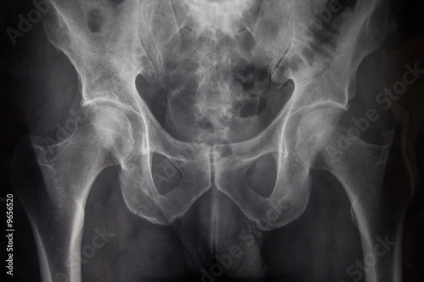 Obraz Pelvic x-ray