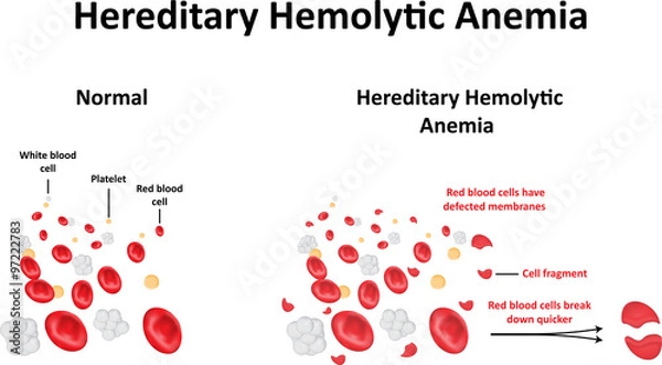 Fototapeta Hereditary Hemolytic Anemia