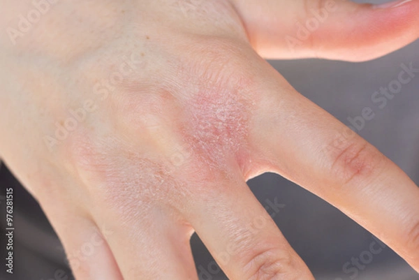 Fototapeta Close-up of a woman’s hands with eczema flare-up between fingers.