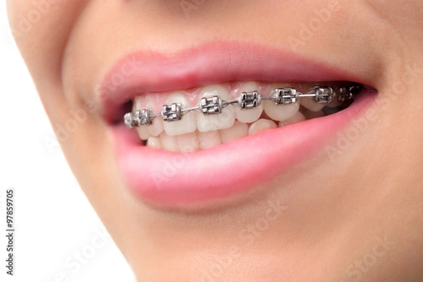 Fototapeta Close-up teeth with braces