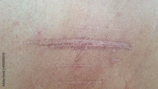 Fototapeta Accidents leave scars on the skin.