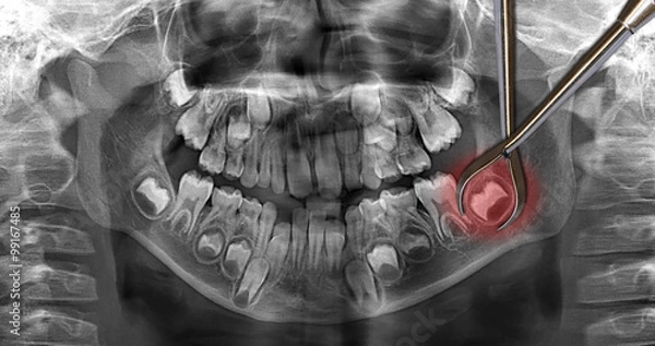Fototapeta dental scan: wisdom teeth
